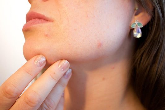 Understanding Pimples: Causes, Effects, and Natural Solutions
