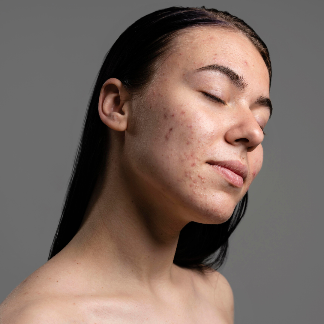 Acne scars